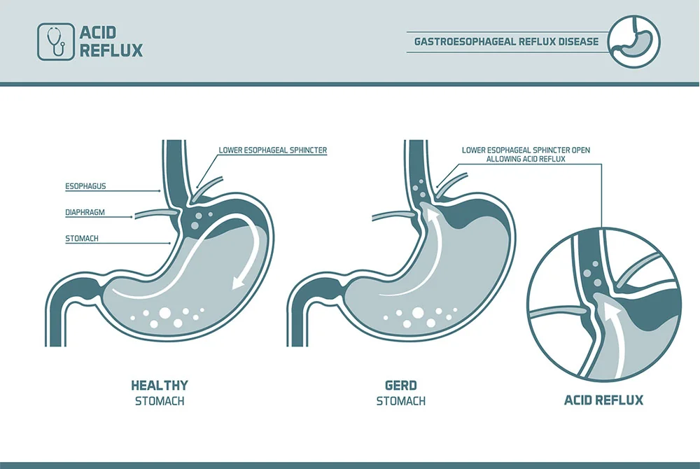 Acid Reflux