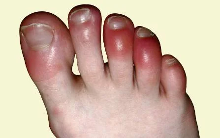 COVID Toes COVID Toes