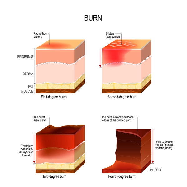 Burn