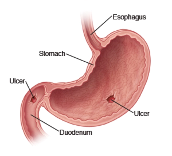 Peptic Ulcer Peptic-Ulcer