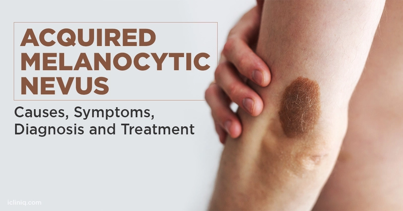 Acquired Melanocytic Nevus- Causes, Symptoms, Diagnosis and Treatment Acquired Melanocytic Nevus- Causes, Symptoms, Diagnosis and Treatment