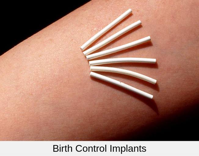 Birth Control Implants Birth Control Implants