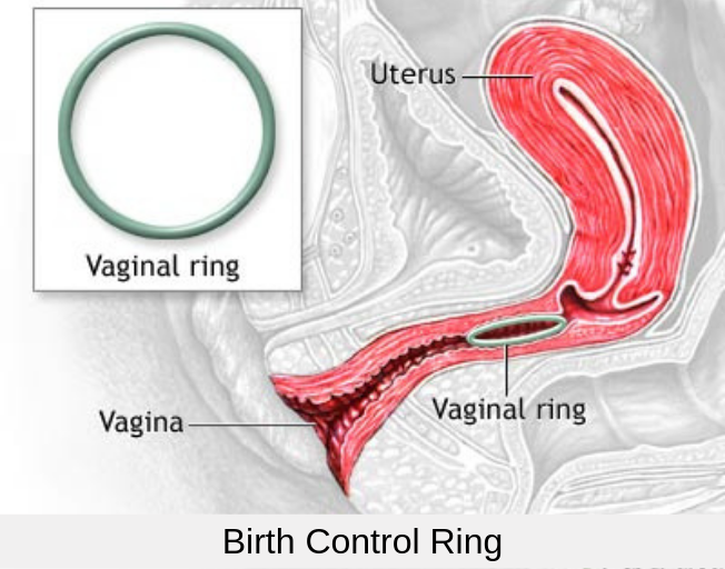 Birth Control Ring Birth Control Ring