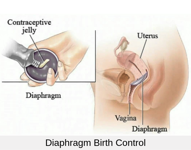 Diaphragm Birth Control Diaphragm Birth Control