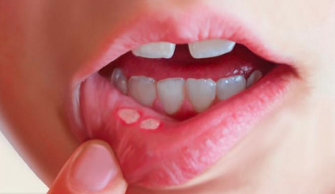 Canker Sores