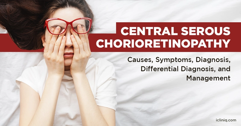 Central Serous Chorioretinopathy - Causes, Symptoms, Diagnosis, Differential Diagnosis, and Management Central Serous Chorioretinopathy - Causes, Symptoms, Diagnosis, Differential Diagnosis, and Management