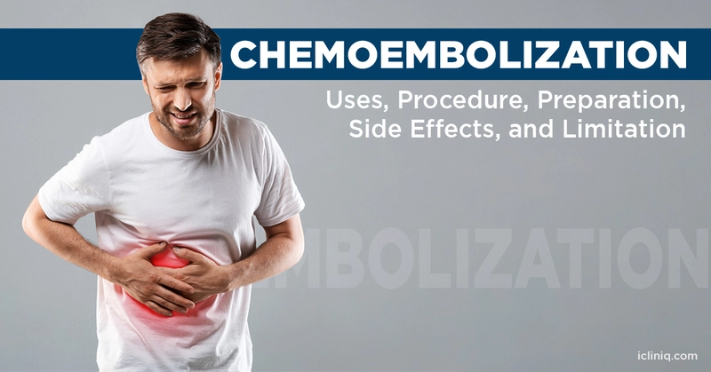 Chemoembolization - Uses, Procedure, Preparation, Side Effects, and Limitation
