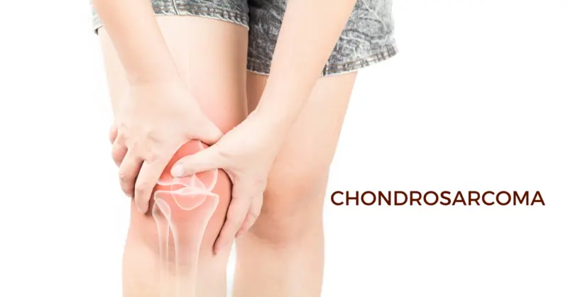Chondrosarcoma - Types, Causes, Symptoms, Diagnosis and Treatment Chondrosarcoma - Types, Causes, Symptoms, Diagnosis and Treatment