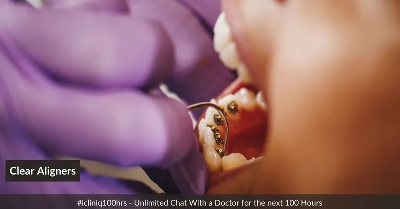 Clear Aligners