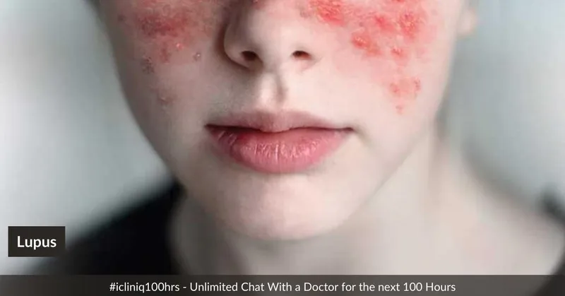 COVID-19 and Lupus COVID-19 and Lupus