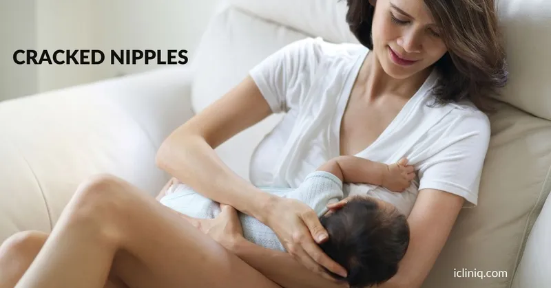 Cracked Nipples - Manifestations, Causes, and Treatment Cracked Nipples - Manifestations, Causes, and Treatment