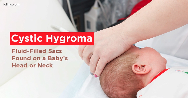 Cystic Hygroma - Fluid-Filled Sacs Found on a Baby’s Head or Neck Cystic Hygroma - Fluid-Filled Sacs Found on a Baby’s Head or Neck