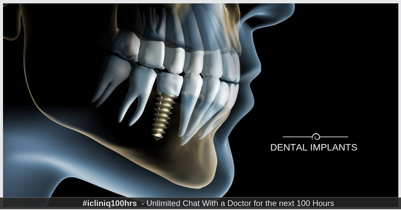 Everything You Need to Know About Dental Implants