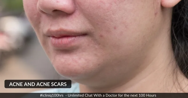 Homeopathic Medicines for Acne and Acne Scars: Benefits and Side Effects
