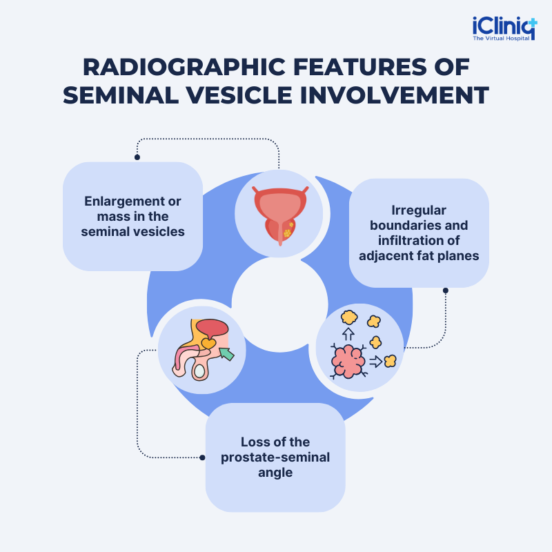 Radiographic features of seminal vesicle involvement Radiographic features of seminal vesicle involvement
