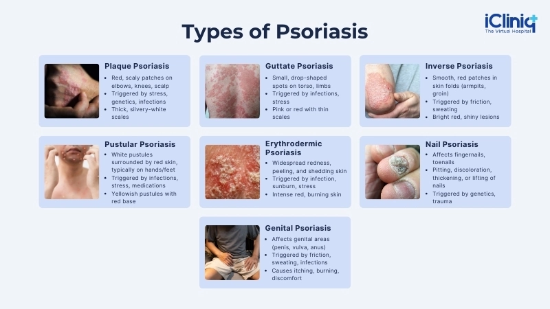 Types of Psoriasis