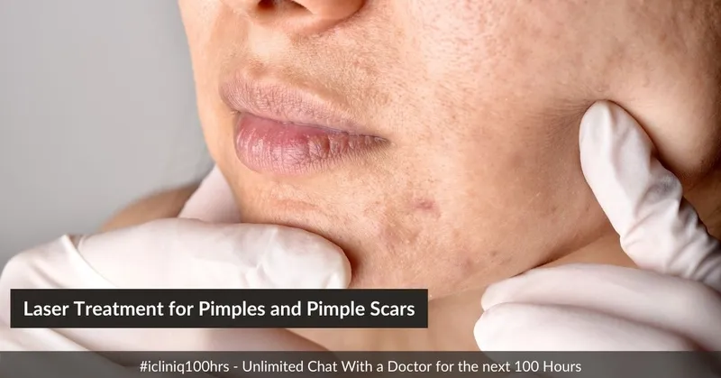 Laser Treatment for Pimples and Pimple Scars Laser Treatment for Pimples and Pimple Scars
