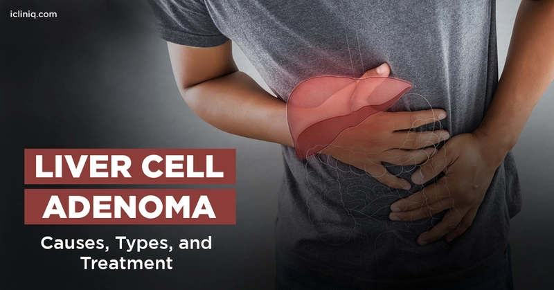 Liver Cell Adenoma - Causes, Types, and Treatment