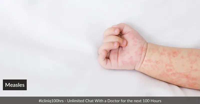 Measles- Risk Factors, Transmission, and Complications Measles- Risk Factors, Transmission, and Complications