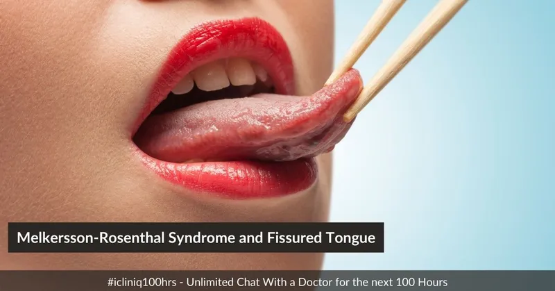 Melkersson-Rosenthal Syndrome and Fissured Tongue Melkersson-Rosenthal Syndrome and Fissured Tongue