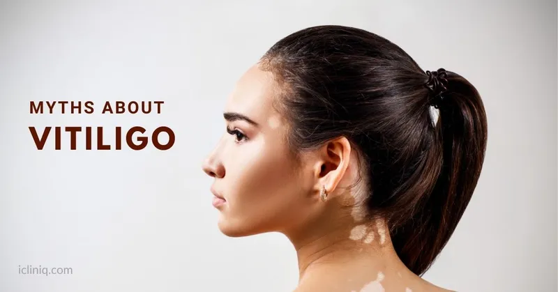 Myths About Vitiligo: Know the Unknown