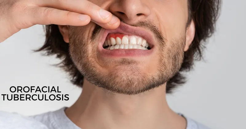 Orofacial tuberculosis - Symptoms, Diagnosis and Treatment Orofacial tuberculosis - Symptoms, Diagnosis and Treatment