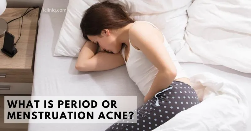 What Is Period or Menstruation Acne?