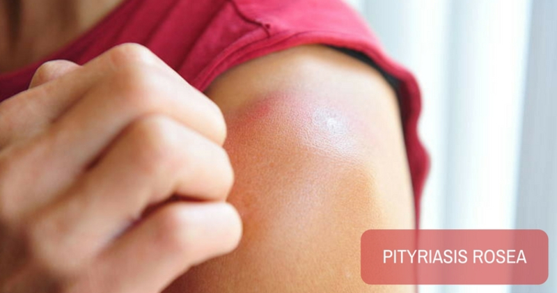 Pityriasis Rosea, a Common Papulosquamous Disorder Pityriasis Rosea, a Common Papulosquamous Disorder