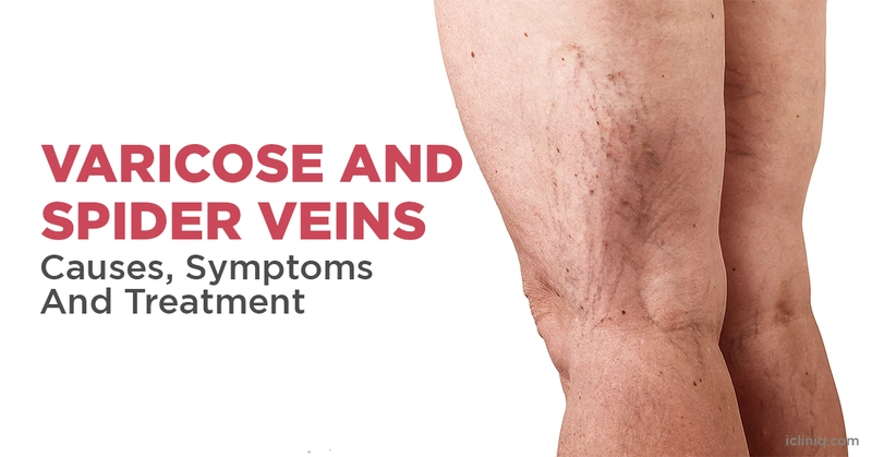 Varicose And Spider Veins- Causes, Symptoms And Treatment Varicose And Spider Veins- Causes, Symptoms And Treatment