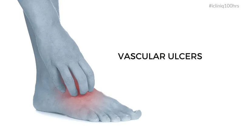 Vascular Ulcers - Types, Symptoms, Risk Factors, Treatment, and Prevention Vascular Ulcers - Types, Symptoms, Risk Factors, Treatment, and Prevention