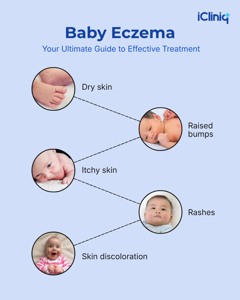 Baby Eczema