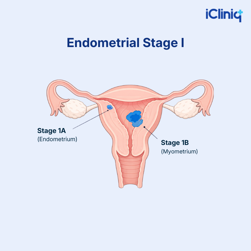 Stage 1 Endometrial Cancer