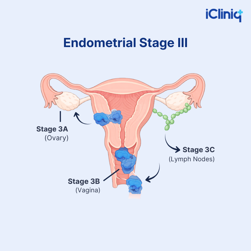 Stage 3 Endometrial Cancer