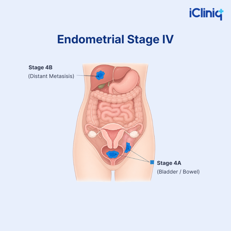 Stage 4 Endometrial Cancer