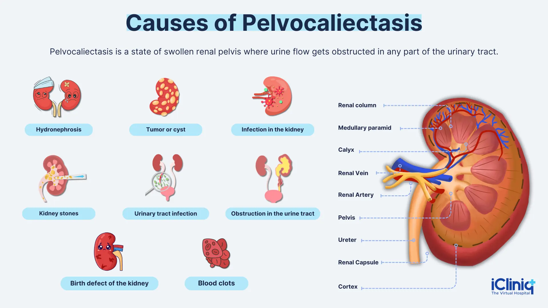 Causes of Pelvocaliectasis