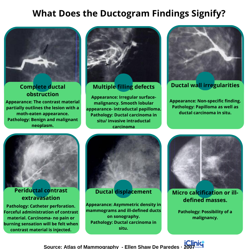 Ductogram Ductogram