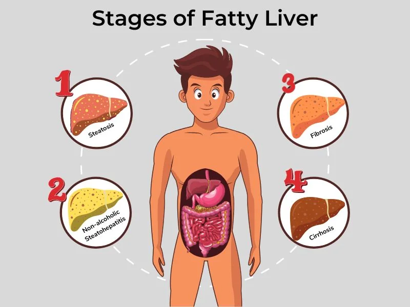 Fatty liver