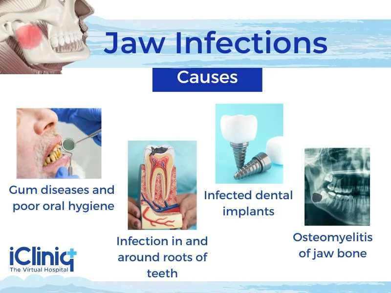 Causes of Jaw Infections