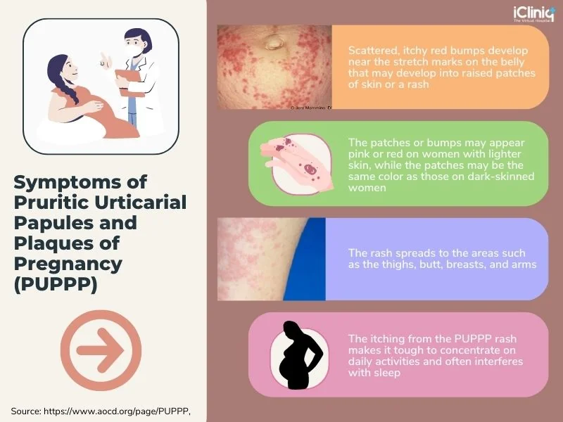 Symptoms of PUPPP