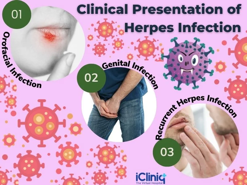 Herpes infection