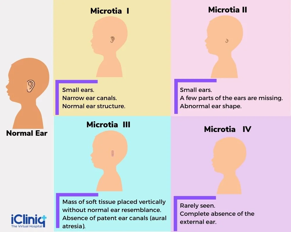 classification-of-microtia