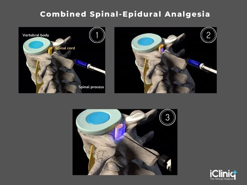 combined spinal-epidural-analgesia combined spinal-epidural-analgesia