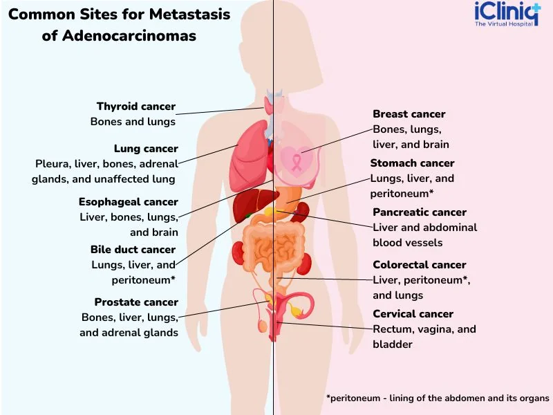 common-sites-for-metastasis