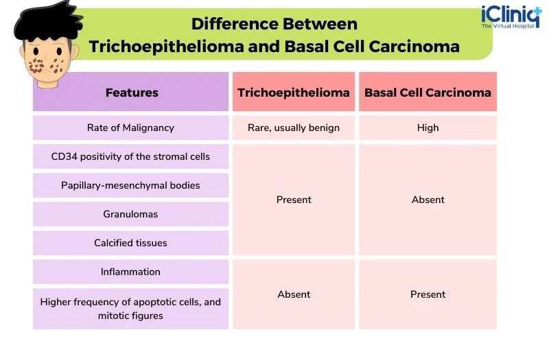 Difference Between Trichoepithelioma and Basal Cell Carcinoma Difference Between Trichoepithelioma and Basal Cell Carcinoma