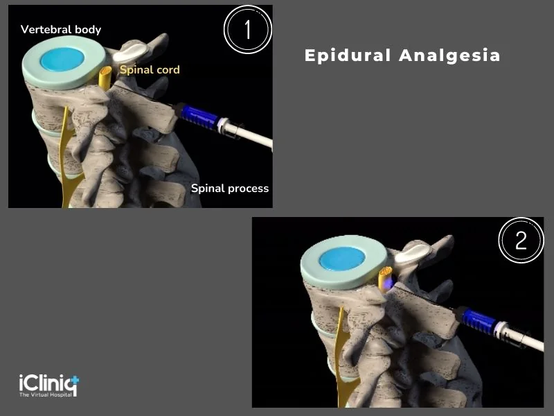 epidural-analgesia epidural-analgesia