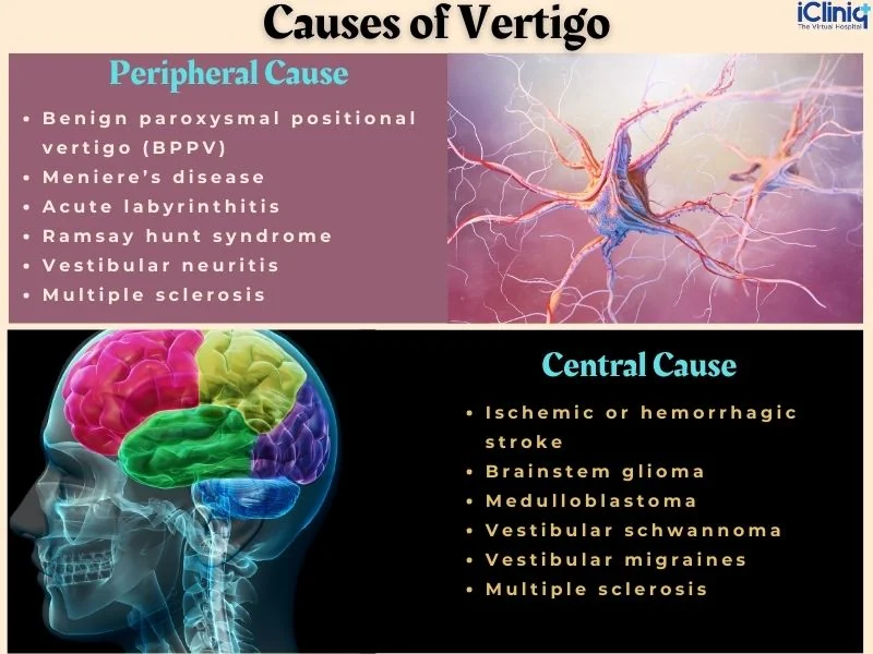 What Are the Possible Causes of Vertigo