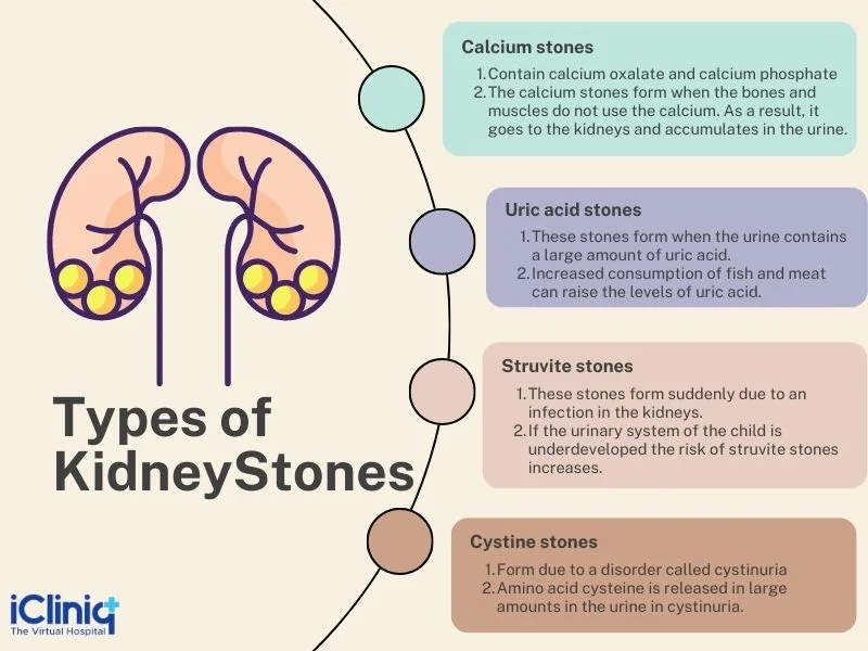 Types of Kidney Stones Description Types of Kidney Stones Description