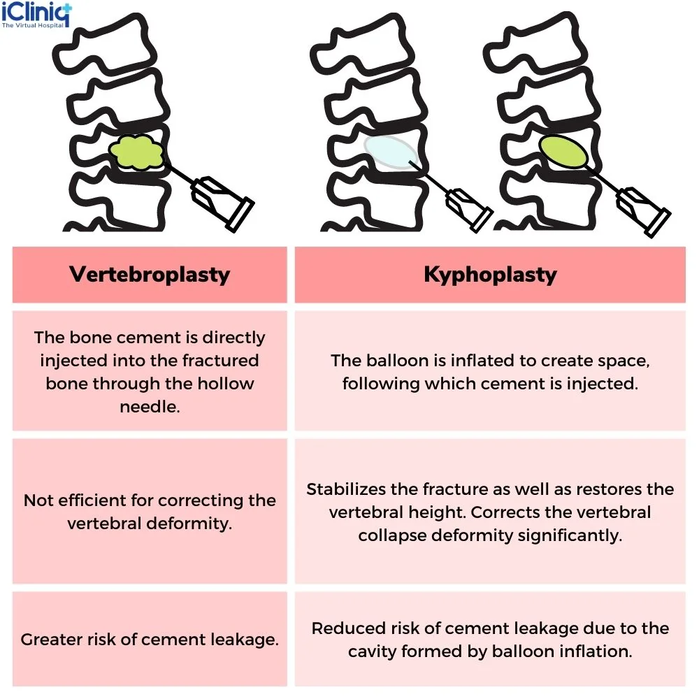 Vertebroplasty and Kyphoplasty