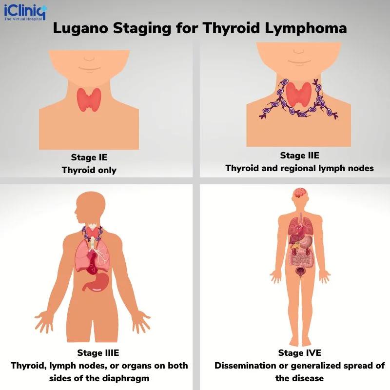 Staging for Thyroid Lymphomas Done