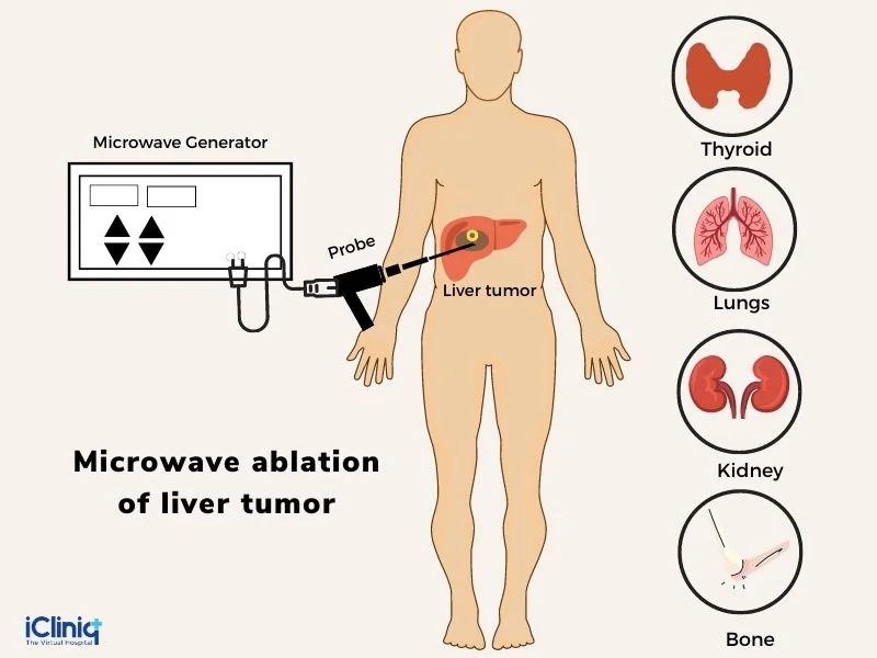 microwave-ablation-of-liver-tumor